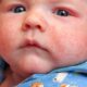 Сыпь у ребенка: причины и лечение
